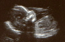 ultrasound scan of baby in womb