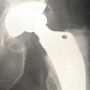 X-ray of human hip showing replacement joint